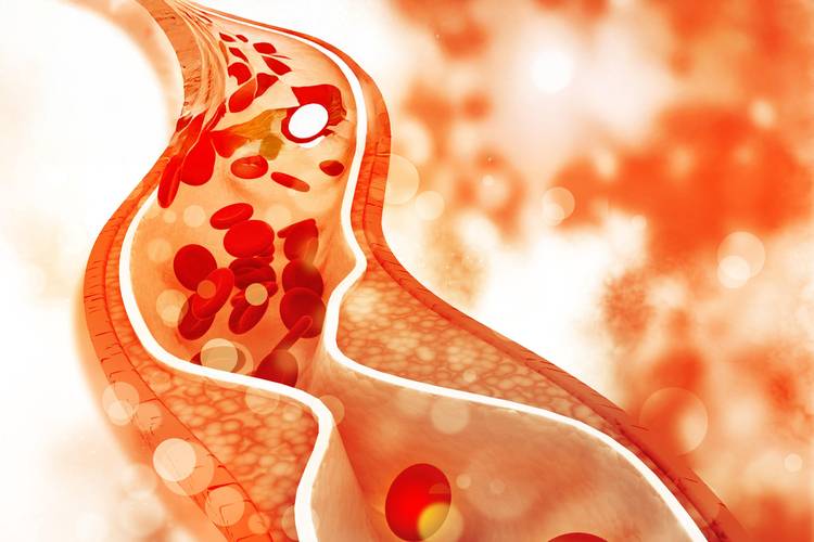 high cholesterol treatment in dubai